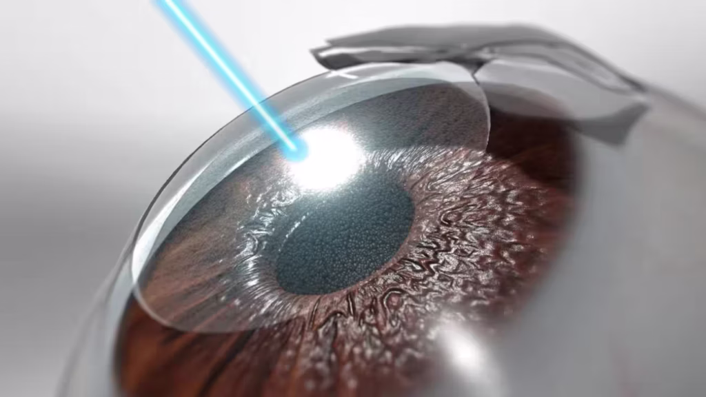 Laser vision correction تصحيح النظر بالليزر