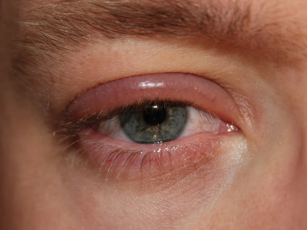 blepharitis treatment in dubai