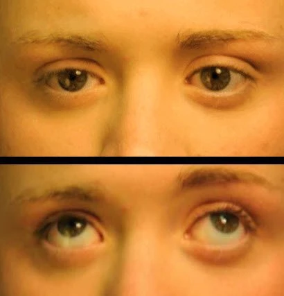 wobbly eyes treatment in dubai nystagmus