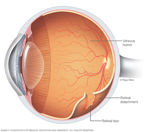 detached retina surgery in dubai