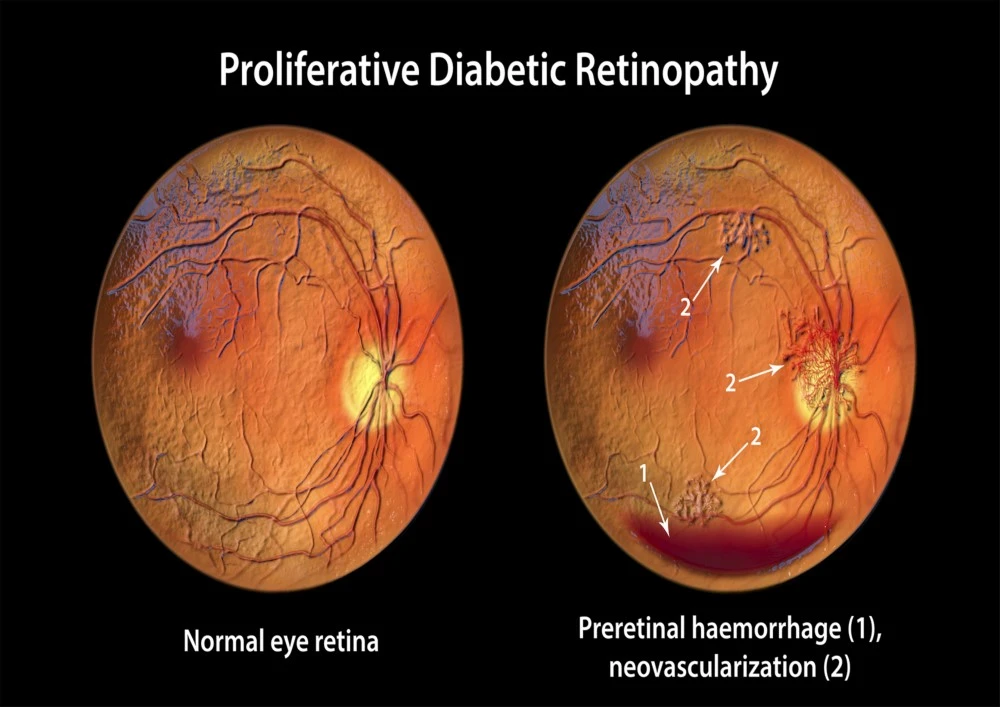diabetic retinopathy treatment in dubai