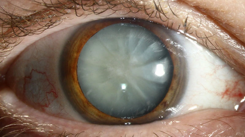 cataract eye surgery