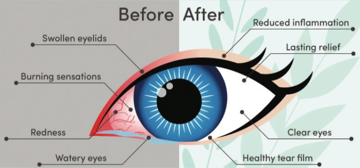 dry eye treatment dry eyes