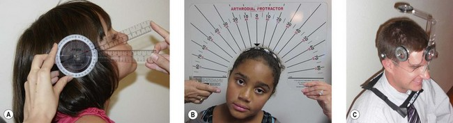 abnormal head posture treatment in dubai ocular torticollis