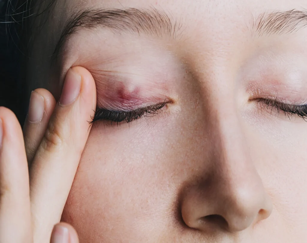 chalazion treatment chalazion eye
