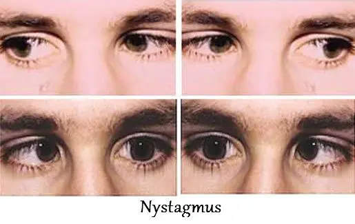 wobbly eyes treatment in dubai nystagmus