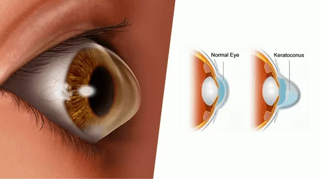 keratoconus treatment in dubai