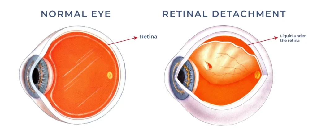 detached retina surgery in dubai