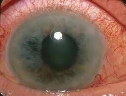 glaucoma treatment in dubai