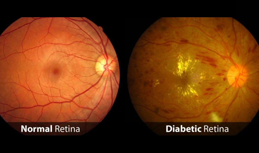 diabetic retinopathy treatment in dubai