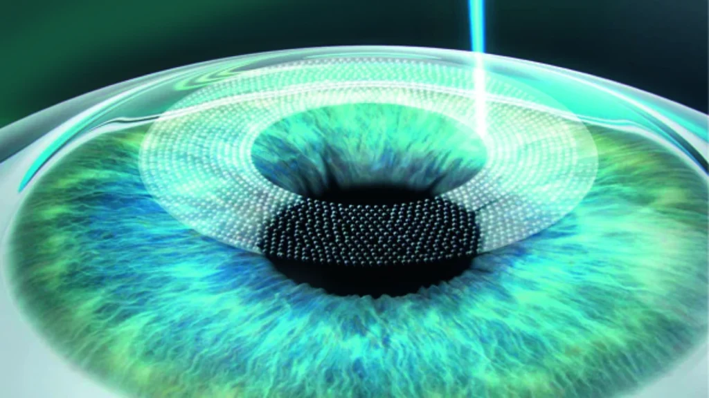 femto lasik eye surgery femtolasik eye surgery