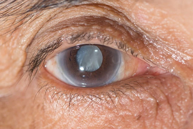 cataract eye surgery