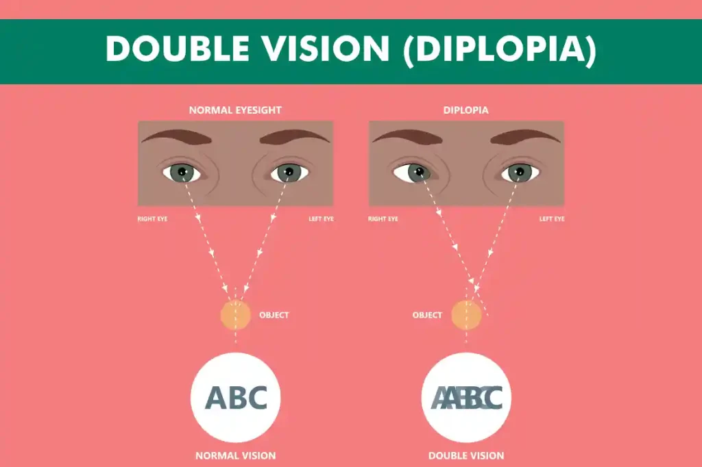 double vision treatment diplopia