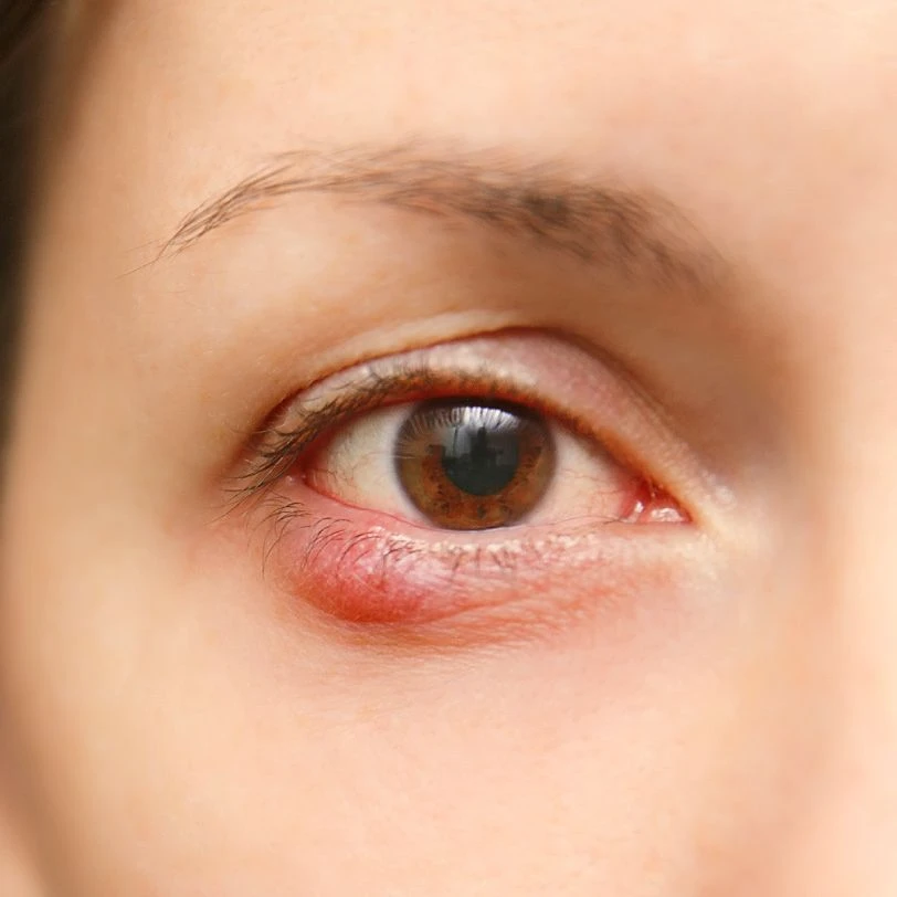 blepharitis treatment in dubai