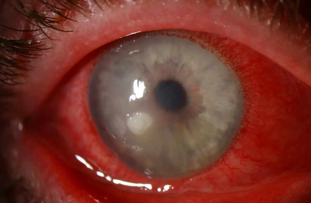 corneal ulcer treatment in dubai Keratitis