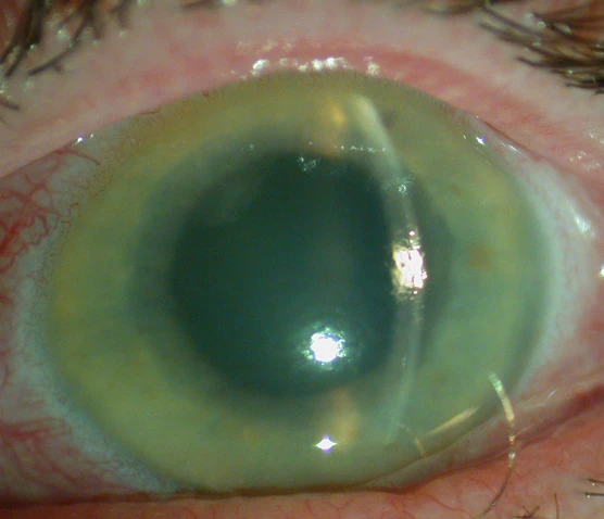 glaucoma treatment in dubai