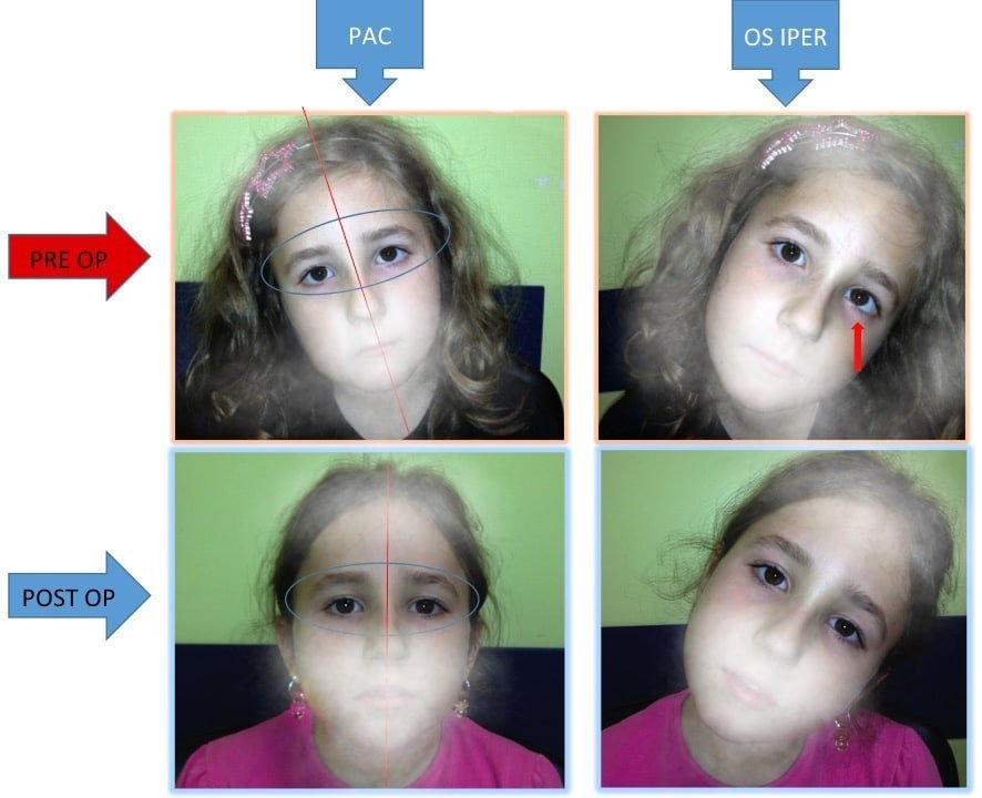 abnormal head posture treatment in dubai ocular torticollis