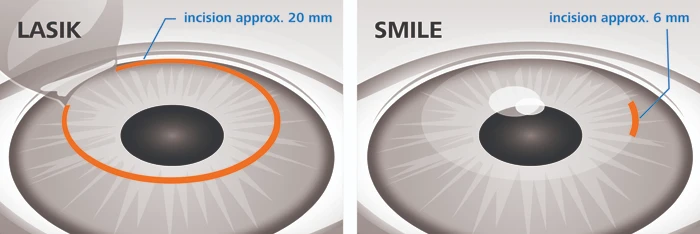 Small Incision Lenticule Extraction SMILE lasik eye surgery dubai
